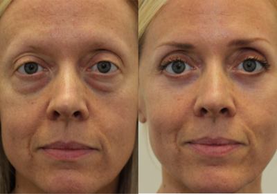 Lower blepharoplasty with fat grafting and fractional laser resurfacing for eye bags - She underwent transconjunctival lower blepharoplasty with fat grafting to under-eyes and cheeks and CO2 laser to lower eyelid skin