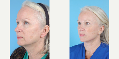 55-64 year old woman treated with Fraxel Repair - A 58 year-old woman before and after Cheek and Neck Lift w/Anterior Platysmaplasty followed by a second stage Fractionated CO2 (Fraxel Repair) laser skin resurfacing by Andrew T. Lyos M.D., FACS.