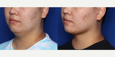 Woman treated with FaceTite - Woman treated with FaceTite