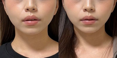 25-34 year old woman treated with Lipodissolve - Fat-dissolving injections to contour the facial line