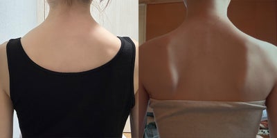 25-34 year old woman treated with Lipodissolve - Fat-dissolving injections to contour the shoulder line