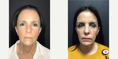Woman treated with Mini Facelift - Woman treated with Mini Facelift- 3 months post-op