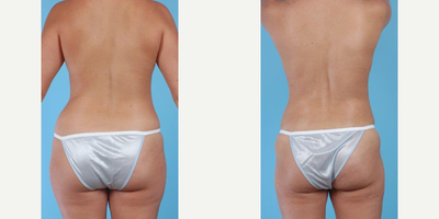 25-34 year old woman treated with Mommy Makeover - A 28 year old woman before and after Abdominoplasty w/Liposuction Abdomen, Waist, Mons, Outer Thighs, and Hips by Andrew T. Lyos M.D FACS. She also had a Bilateral Breast Augmentation with placement of Mentor Smooth Round Moderate Plus Profile Memory Gel Silicone Implants 300cc on the left side and 300cc on the right side, placed in a submuscular pocket and dual plane. She went from a 32A to a 32C.