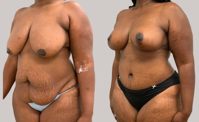 35-44 year old woman treated with Mommy Makeover - 35-44 year old woman treated with Mommy Makeover
