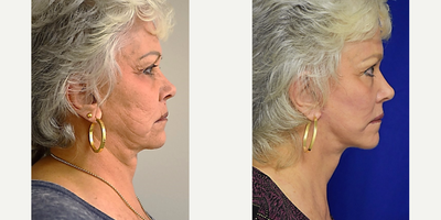 65-74 year old woman treated with Neck Lift in Metairie, LA - This pleasant woman from New Orleans has dramatic improvements in the cheek, Jowl areas as well as along the jawline and neck. She underwent a facelift, necklift, and laser skin resurfacing under local anesthesia in the office of Dr. Sean Weiss in Metairie, Louisiana