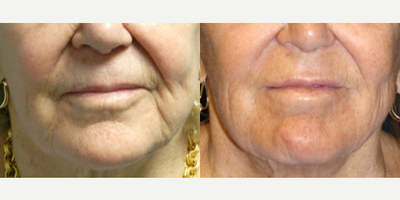 Woman treated with Laser Resurfacing, Microneedling RF - Woman treated with Laser Resurfacing, Microneedling RF
