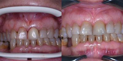 55-64 year old woman treated with Dental Implants, Dental Bone Graft, Dental Crown - 61 years old female patient had an infected upper central incisor tooth which needed to be extracted. 3-D CT plan has indicated the bone is good enough for an implant treatment.Tooth has been extracted carefully to preserve bone and soft tissues. An implant has been placed according to 3D plan. Bone graft has been placed into the gap between implant and extraction socket.Immediate loading temporary was delivered at the day of surgery. This helped us to preserve the shape of gingiva which is very important for pink esthetic in anterior single implant cases. This temporary proshtesis was adjusted to avoid contact with opposing tooth which offered a reasonable aesthetic.In the end of 3 months of healing period, E-max crown over custom zirconia abutment has been delivered to achieve a perfect esthetic result.The result was nice.