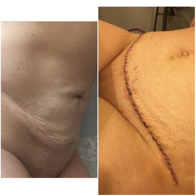 can you get lipo after c section Loose Skin from Lipo and C-section (Scar Repair)