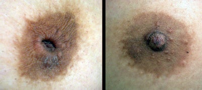 Inverted Nipple Correction - Inverted Nipple Correction Surgery. Close up.