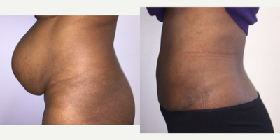 25-34 year old woman treated with Umbilical Hernia Repair - Woman decided to have Tummy Tuck and Hernia Repair.
