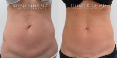35-44 year old woman treated with SculpSure - Upper and lower abdomen. Photo taken 13 weeks post-op.