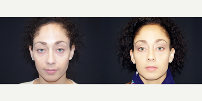 25-34 year old woman treated with Belotero; 1 month post-op - 32 year old female received 1 syringe of Belotero filler under her eyes; photos depict the patient's results 1 month post-treatment.