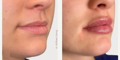 Woman treated with Lip Fillers - Woman treated with Lip Fillers