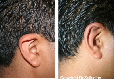 Ear Surgery - Otoplasty