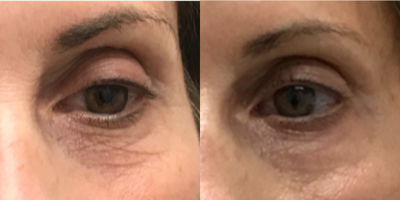 55-64 year old woman treated with Exilis - 4 monthly sessions for Exilis treats Crepiness around eyes.