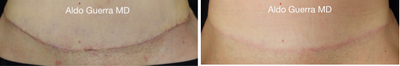45-54 year old woman treated with Embrace Scar Therapy - Close up photos of a tummy tuck incision treated with embrace Active Scar Defense before and after 5 months post op.