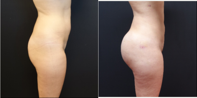 25-34 year old woman treated with Butt Augmentation - The patient underwent a butt augmentation with 548cc round silicone butt implants and fat transfer. She also had liposculpting of the abdomen, back and flanks. The combination of her liposuction and butt augmentation transforms her from a square to an hour-glass figure.