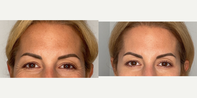 35-44 year old woman treated with Xeomin - patient treated with xeomin in crows feet
