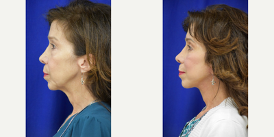 55-64 year old woman treated with Facelift, Neck Lift, Double Eyelid Surgery, Ptosis Surgery, Brow Lift - 3694 Treated with Facelift, Neck Lift, Double Eyelid Surgery, Ptosis Surgery, Brow Lift