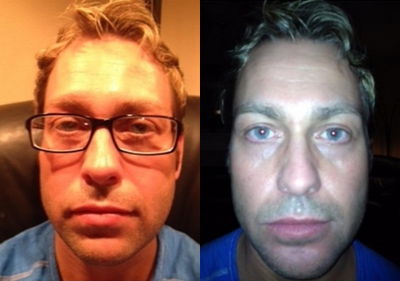 25-34 year old man treated with Chin Implant - Chin Augmentation using an implant performed on 34 year old male.