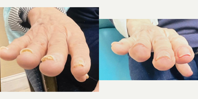 65-74 year old woman treated with Laser Toenail Fungus Removal - Before and after 3 laser fungus removal treatments on the fingernails.