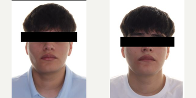 Man treated with Jaw Surgery - Man treated with Jaw Surgery