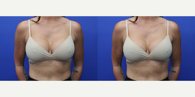 25-34 year old woman treated with Breast Augmentation - 34 year old woman who had 560cc Mentor Smooth Round Moderate High profile Xtra Silicone Gel Implants placed in the submuscular plane via an IMF approach