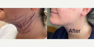 Woman treated with Smart Lipo, Chin Liposuction, Liposculpture - Smartlipo triplex laser liposuction of the neck & jowls.