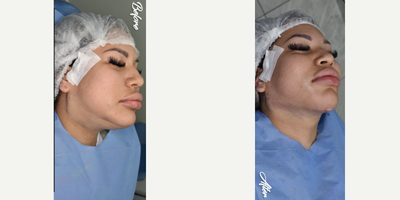 25-34 year old woman treated with Aqualyx, Botox, Kybella - i did double chin removal and marking jawline.