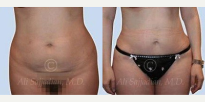 Woman treated with Mini Tummy Tuck - Mini Tummy Tuck