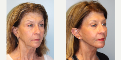 55-64 year old woman treated with Facelift - 1 year follow up after a facelift performed by Dr. Bryson Richards.
