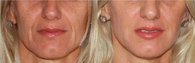 Treated with Liquid Facelift - Treated with Liquid Facelift