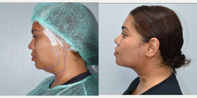 25-34 year old woman treated with Kybella, Aqualyx, Botox - i did double chin removal and marking jawline.