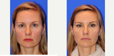 45-54 year old woman treated with Voluma - This patient had Voluma, Botox, and Restylane Injections. These are her before and after photos.