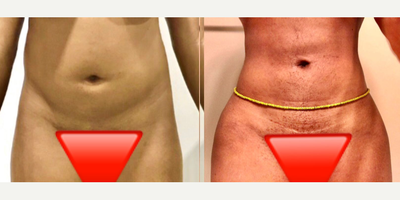 18-24 year old woman treated with Liposuction, BodyTite - 18-24 year old woman treated with Liposuction, BodyTite
