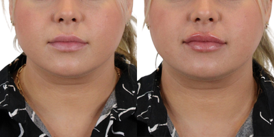 25-34 year old woman treated with Lip Fillers, Restylane, Restylane Defyne, Restylane Refyne, Juvederm, Dermal Fillers, RHA Coll - We love good lip refresh! Take a look at the stunning results of our patients lip filler treatment! 