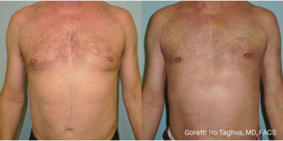 Man treated with Gynecomastia Surgery - Man treated with Gynecomastia Surgery