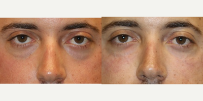 37 year old man treated with Juvederm Voluma to lower eyelids - Juvederm Voluma to bilateral lower eyelids