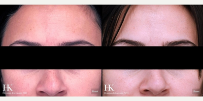 Woman treated with Clear and Brilliant - Woman treated with Clear and Brilliant