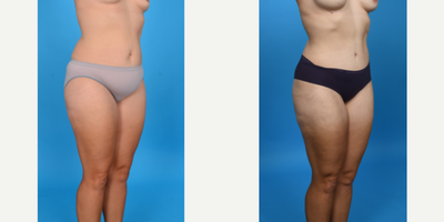 35-44 year old woman treated with Abdominal Etching, Diastasis Recti Repair, Drainless Tummy Tuck, Liposculpture, Liposuction, M - Before and after tummy tuck with lipo 360. This patient had a tummy tuck as part of her mommy makeover. She has excess skin and fat primarily below her belly button and in her suprapubic area. I did a low bikini incision removing all skin and fat from her belly button to her pubic area. I did a corset muscle plication of her stretched abdominal muscles. I did VASER ultrasound liposuction of her abdomen, flanks to shape her waist.