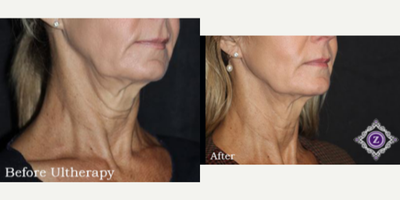 55-64 year old woman treated with eMatrix - The doctor used Sublative and Ultherapy to tighten her patient's neck and jawline area.