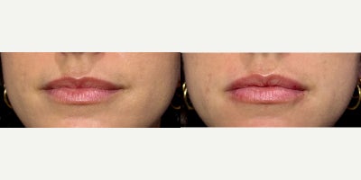 35-44 year old woman treated with Juvederm - Non-Surgical Lip Augmentation using half of a syringe of Juvederm