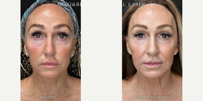 55-64 year old woman treated with Moxi - BBL and Moxi for pigmentation and texture