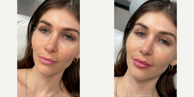 18-24 year old woman treated with Juvederm, Vollure - A woman in her 20s, after the injection of 1cc Juvederm and Vollure into the upper and lower lips.