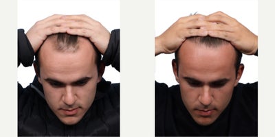 18-24 year old man treated with FUE Hair Transplant, PRP for Hair Loss - Goals: Add more volume and density and restore the front hairlineProcedure: FUE hair transplant and PRP Hair TherapyGrafts: 2500 grafts, zones 1 and 2Photo Timeline: 6 months post-op