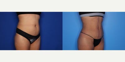 35-44 year old woman treated with BodyTite, Liposuction, Tumescent Liposuction - 41 year old female shown 3 months after BT lipo 360 (abdomen/flanks). She had 1.9 L removed.