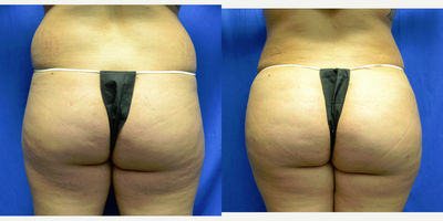 18-24 year old woman treated with Brazilian Butt Lift - 21 year old female 7 weeks after Vaser Liposuction to her back and a Brazilian Butt Lift. Her height is 5 feet 1 inches and weight is 150 lbs. Two liters of fat was removed from the lower back and 500 cc's of fat was transferred to each buttock.