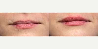 35-44 year old woman treated with Juvederm - 1 syringe Juvederm to upper and lower lip to create a fuller balance. Shown immediately after.
