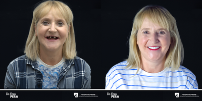 45-54 year old woman treated with All-on-4 Dental Implants, Dental Implants - zygomatic implants