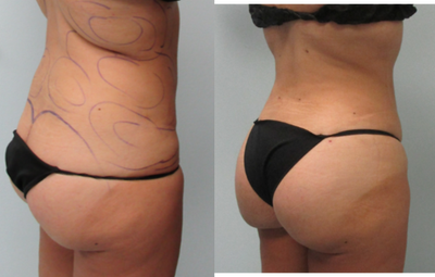 Gruber Booty - Dr. Gruber sculpts your natural tissues to create and uplifted rounder appearance to the buttocks without the addition of fat, injections or implants.